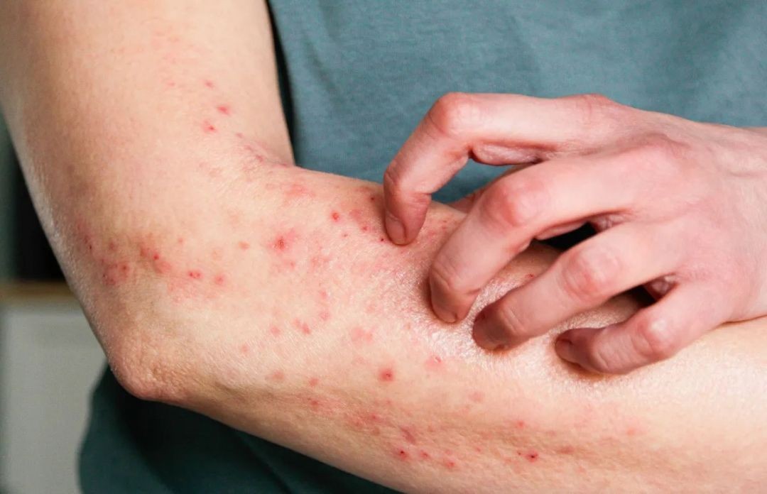Imagem mostra braço de uma pessoa com lesões avermelhadas na pele, características de infecção viral como a Mpox.